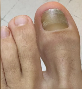 Antes del tratamiento de Onicomicosis (hongo)